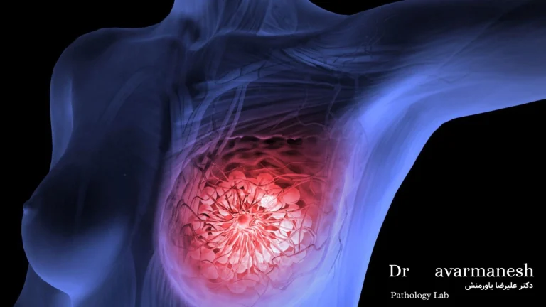 انواع سرطان سینه