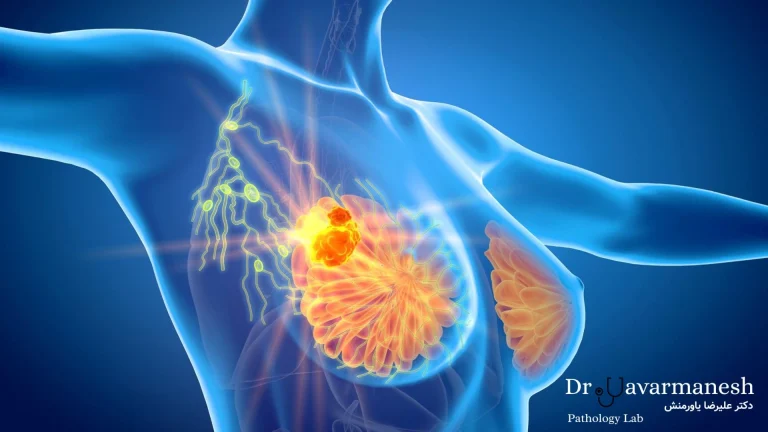 تصویر MRI از پستان برای تشخیص دقیق سرطان سینه