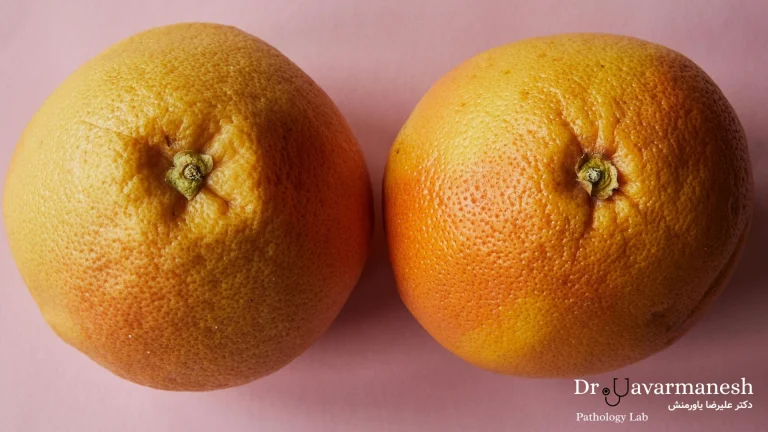 عوامل محیطی و ژنتیکی مؤثر در بروز سرطان سینه