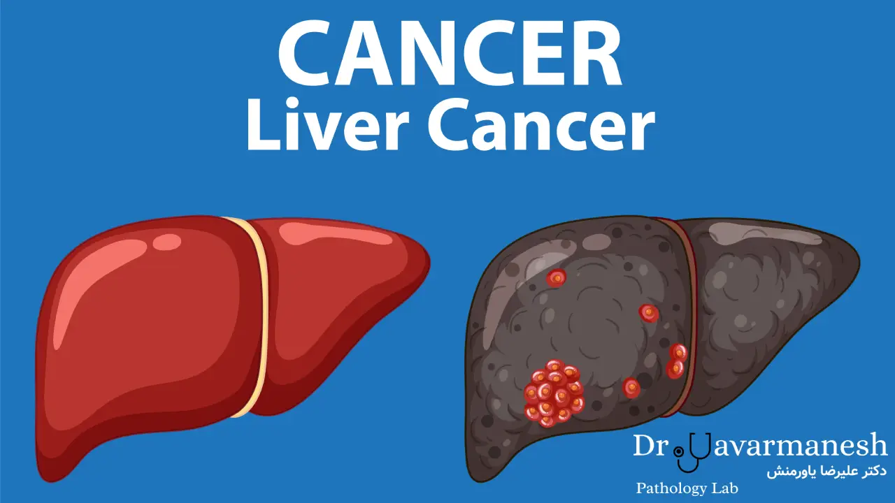 سرطان کبد در سیروز ناشی از کبد چرب
